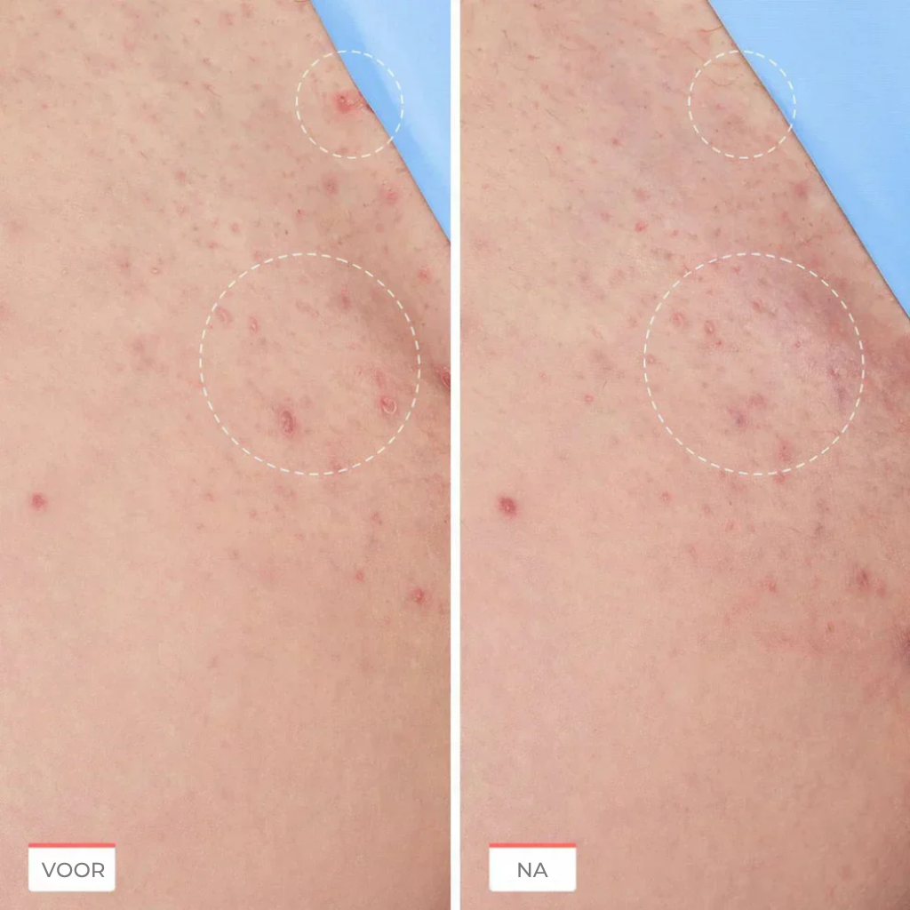 Smoothing Solution Ingrown Hair Treatment